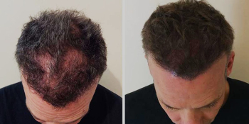 Top Hair Loss In Dallas