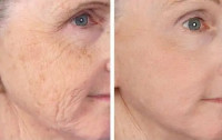 Fractionated CO2 Laser for Acne Scars & Pigmentation in Altamonte Springs, Orlando, Daytona Beach & Clermont